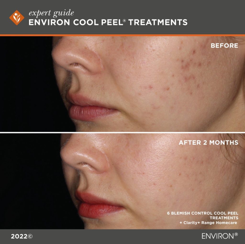 ENVIRON COOL PEEL BLEMISH CONTROL at olive beauty in milton keynes blog