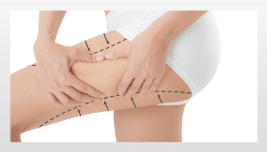 most effective cellulite treatment at olive beauty in milton keynes