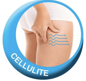 How to stop cellulite on your legs at olive beauty and aesthetics in milton keynes