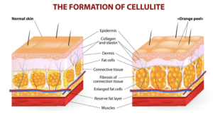 What Is The Best Non Surgical Treatment For Cellulite? at olive beauty and aesthetics in milton keynes