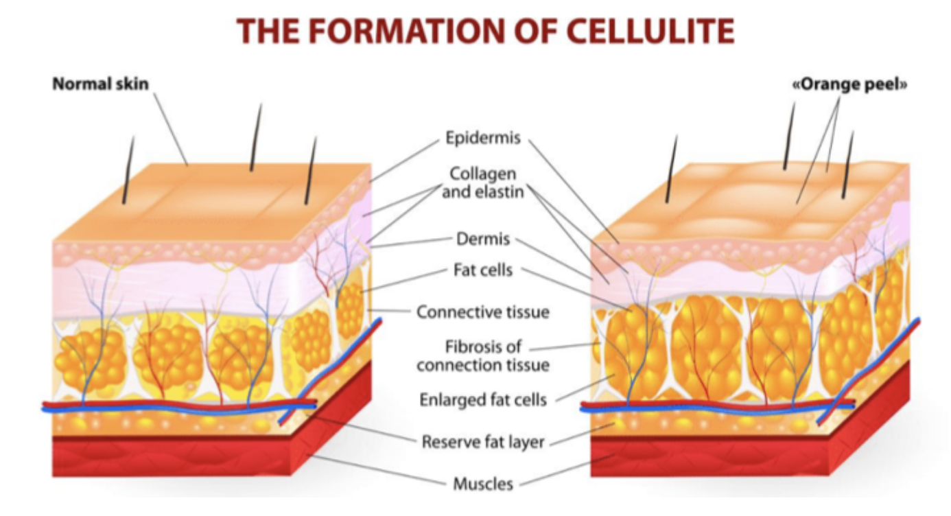 What Is The Best Non Surgical Treatment For Cellulite? at olive beauty and aesthetics in milton keynes