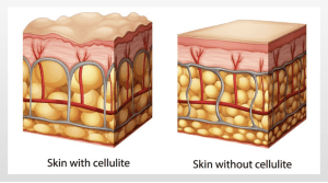 can you really get rid of cellulite at olive beauty & aesthetics in milton keynes