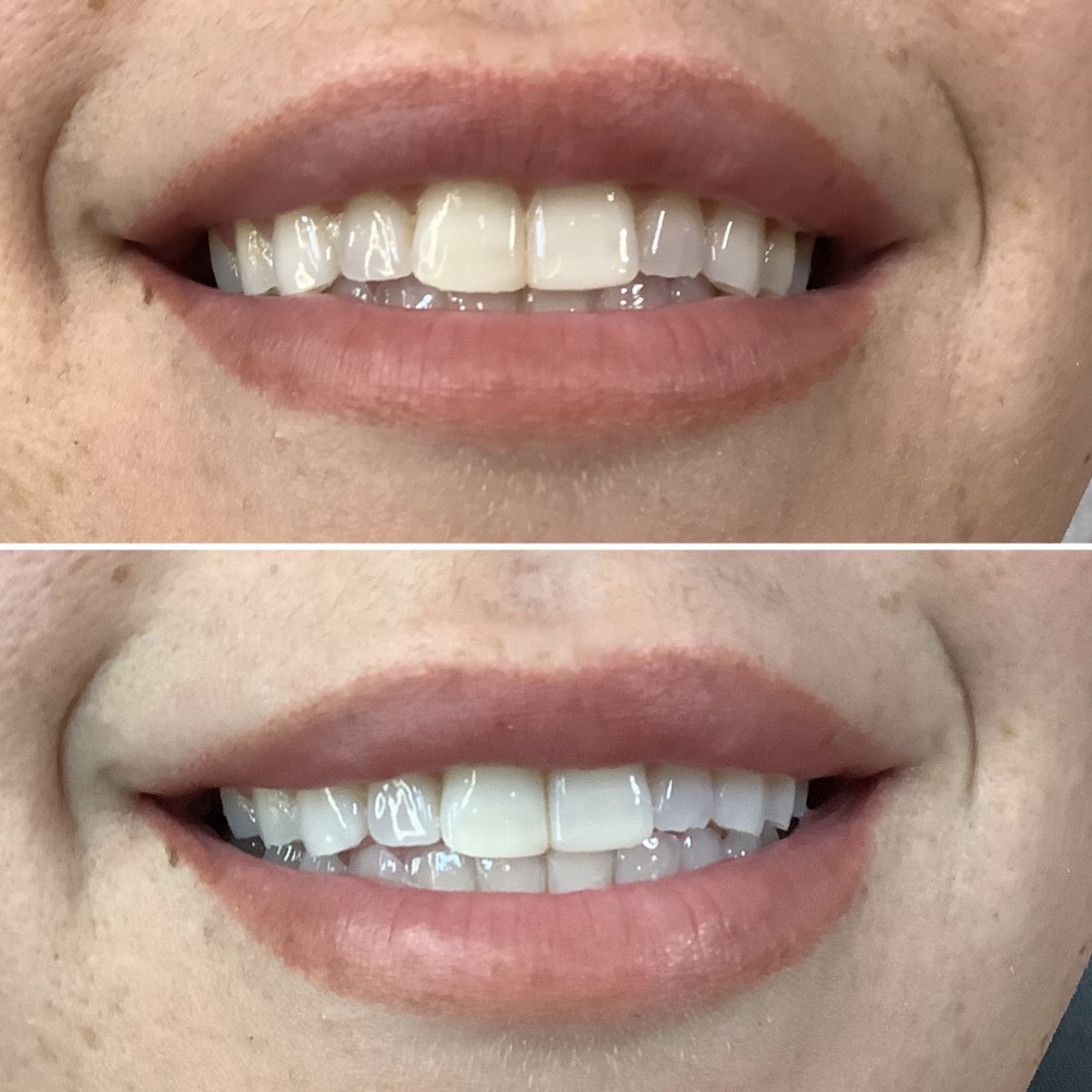 how often can you have laser teeth whitening at olive beauty and aesthetics in milton keynes